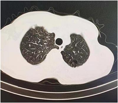 Thermal Volume Reduction Surgery for Surgical Treatment of Pulmonary Bullae: A Single-Center Treatment Experience of 276 Cases Accompany With Primary Lung Cancer